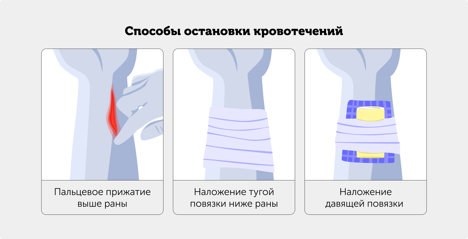 Иллюстрация — способы остановки кровотечений