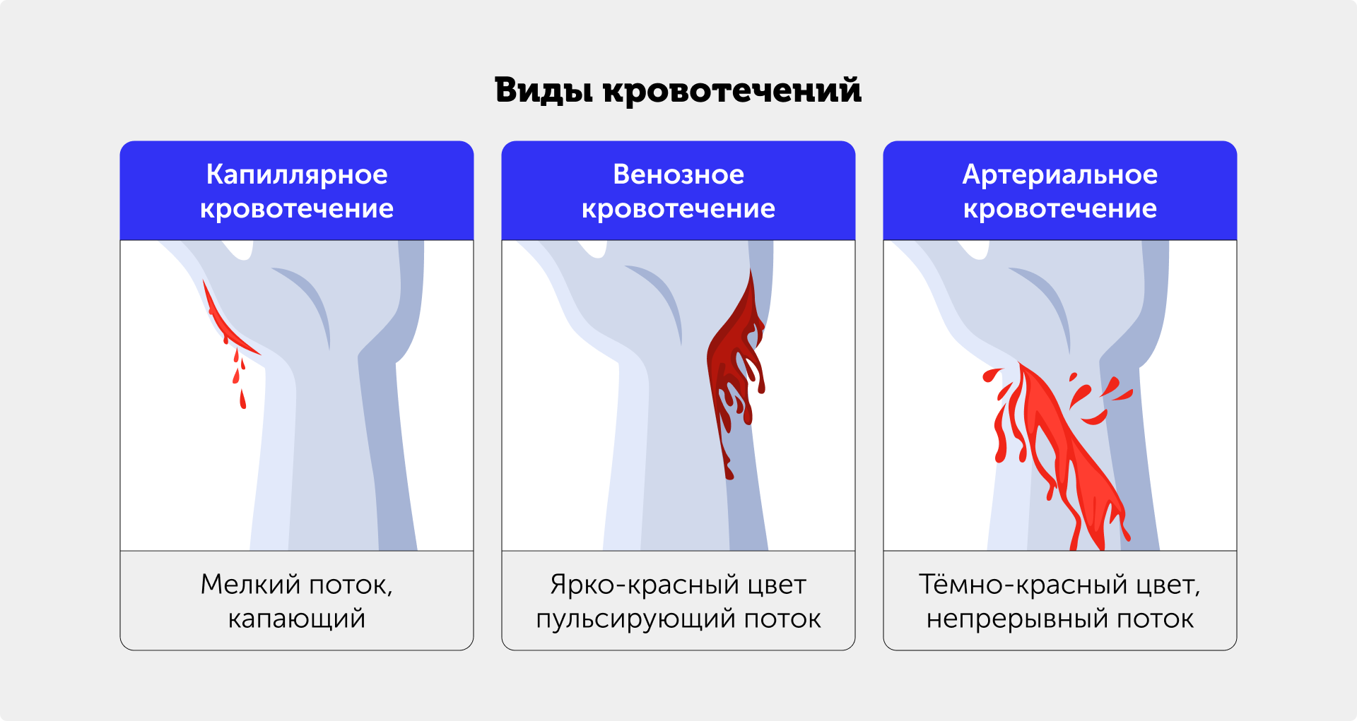 Иллюстрация — виды кровотечений